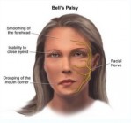 BELL`S PALSY, Akibat Semburan Angin AC